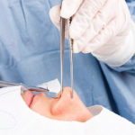 Peut-on faire une rhinoplastie à Lyon si l’on souffre d’apnée du sommeil ?