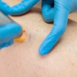 Quels résultats peut-on attendre d’un traitement par Laser varices ?