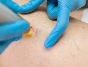 Laser varices