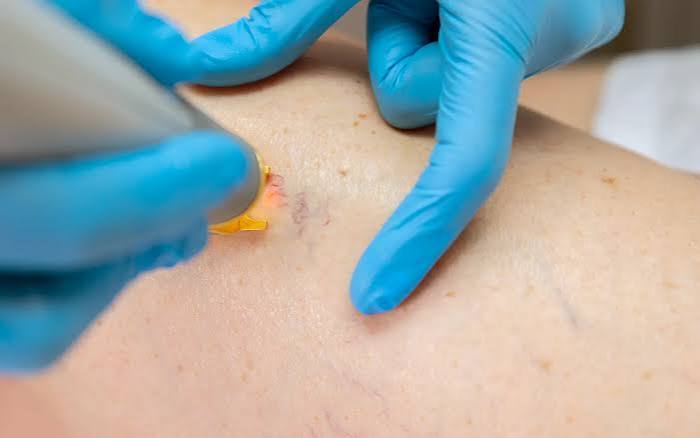 Laser varices